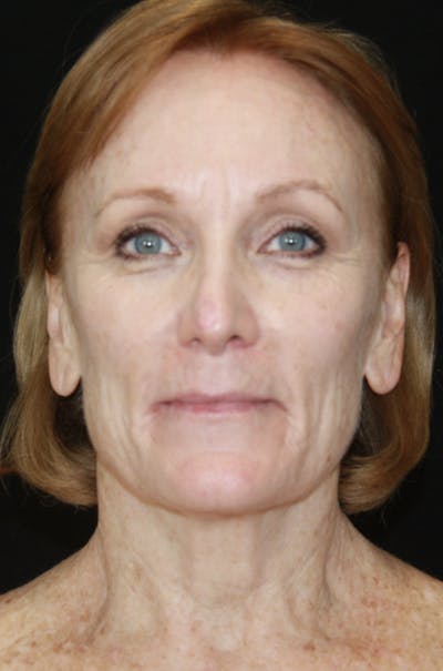 CO2 Laser Resurfacing Before & After Gallery - Patient 173332860 - Image 1