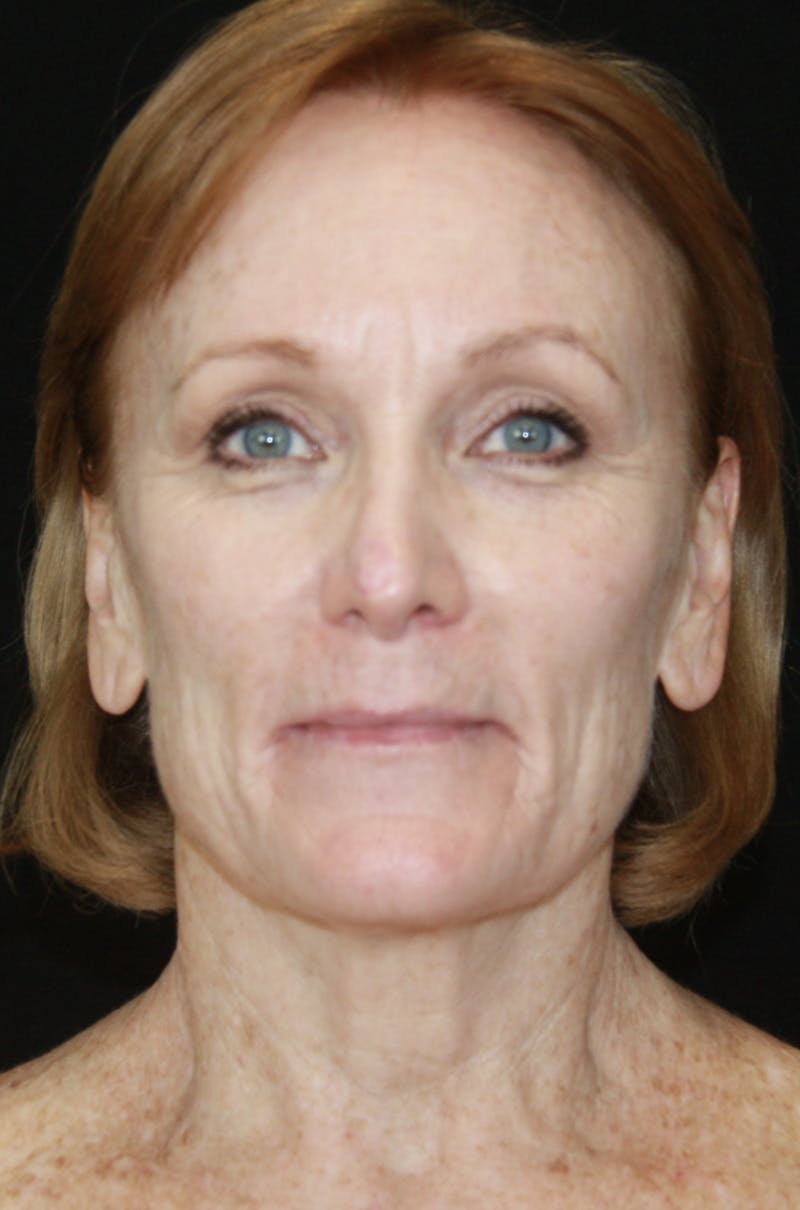 CO2 Laser Resurfacing Before & After Gallery - Patient 173332860 - Image 1