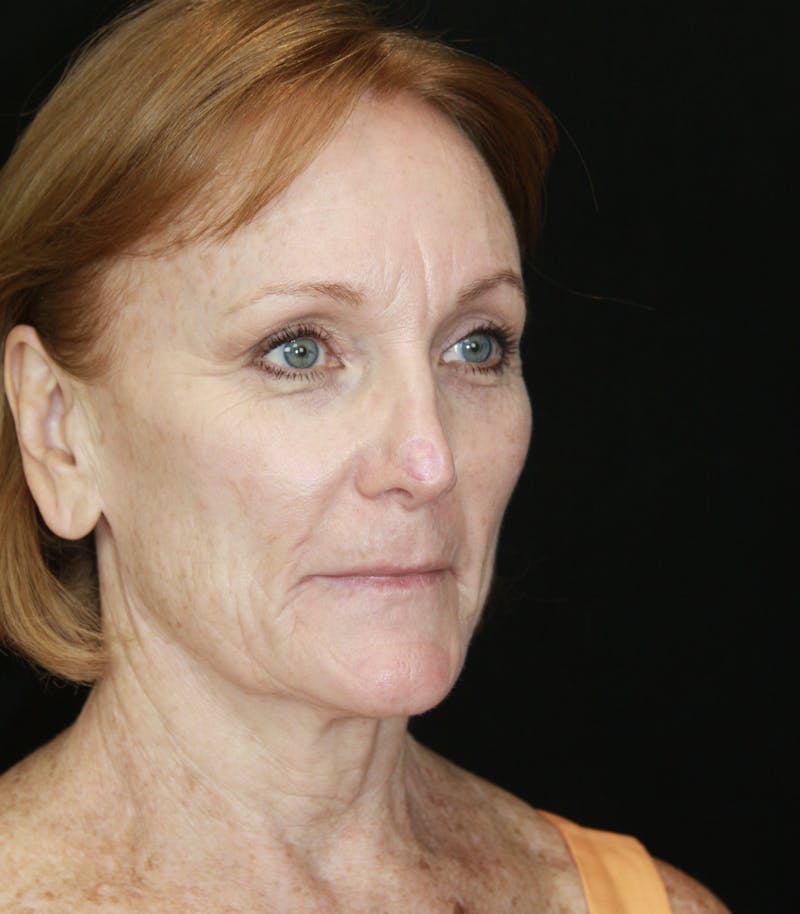 CO2 Laser Resurfacing Before & After Gallery - Patient 173332860 - Image 5