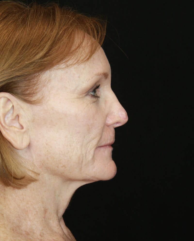 CO2 Laser Resurfacing Before & After Gallery - Patient 173332860 - Image 3
