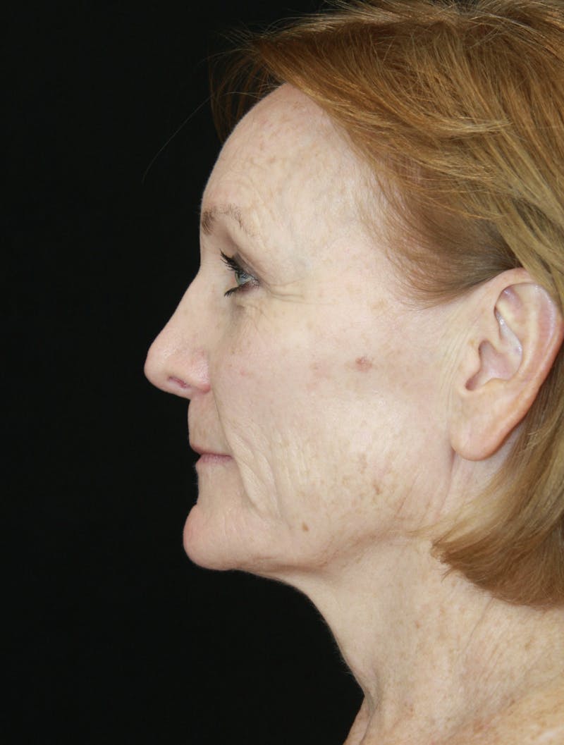 CO2 Laser Resurfacing Before & After Gallery - Patient 173332860 - Image 7