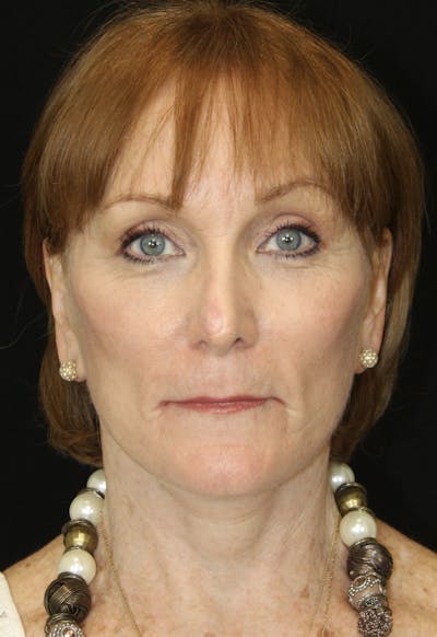 CO2 Laser Resurfacing Before & After Gallery - Patient 173332860 - Image 2