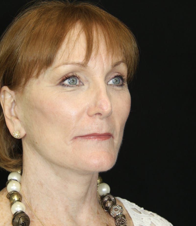 CO2 Laser Resurfacing Before & After Gallery - Patient 173332860 - Image 6