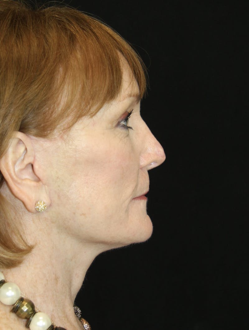 CO2 Laser Resurfacing Before & After Gallery - Patient 173332860 - Image 4