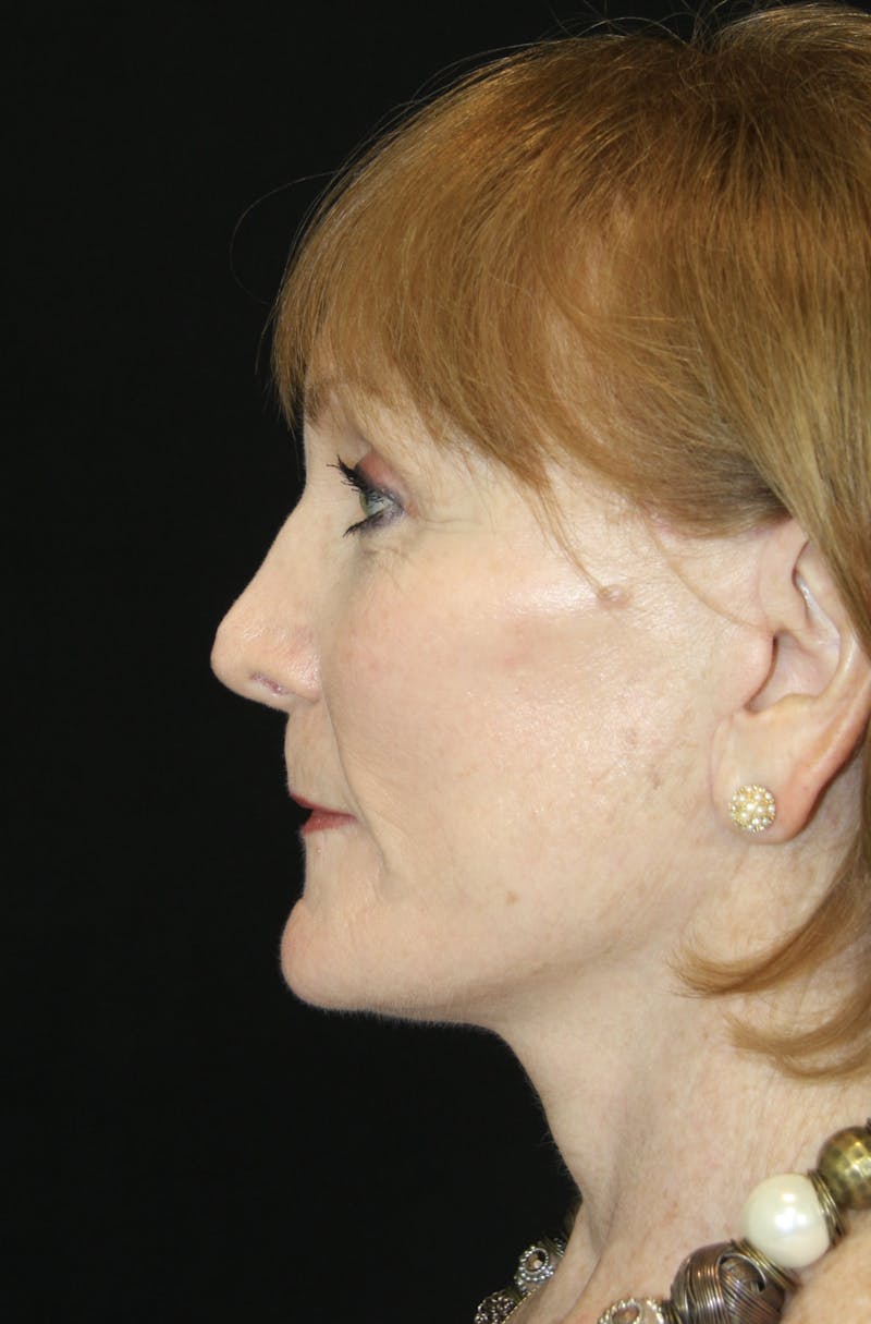CO2 Laser Resurfacing Before & After Gallery - Patient 173332860 - Image 8