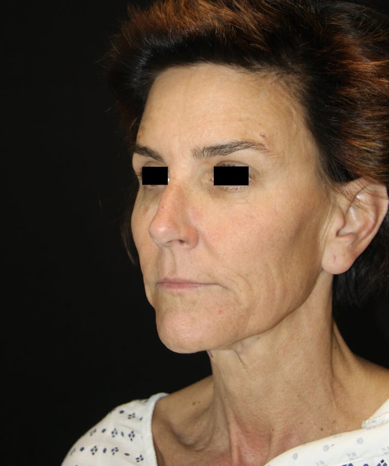 Facelift & Neck Lift Before & After Gallery - Patient 173336136 - Image 1