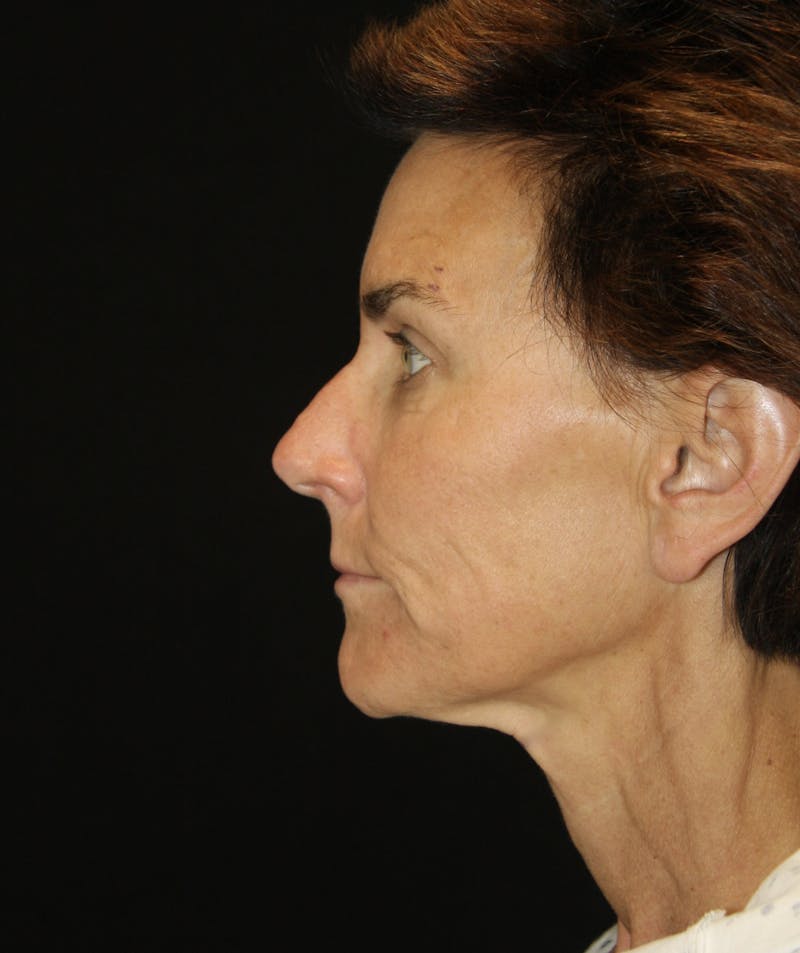 Facelift & Neck Lift Before & After Gallery - Patient 173336136 - Image 3