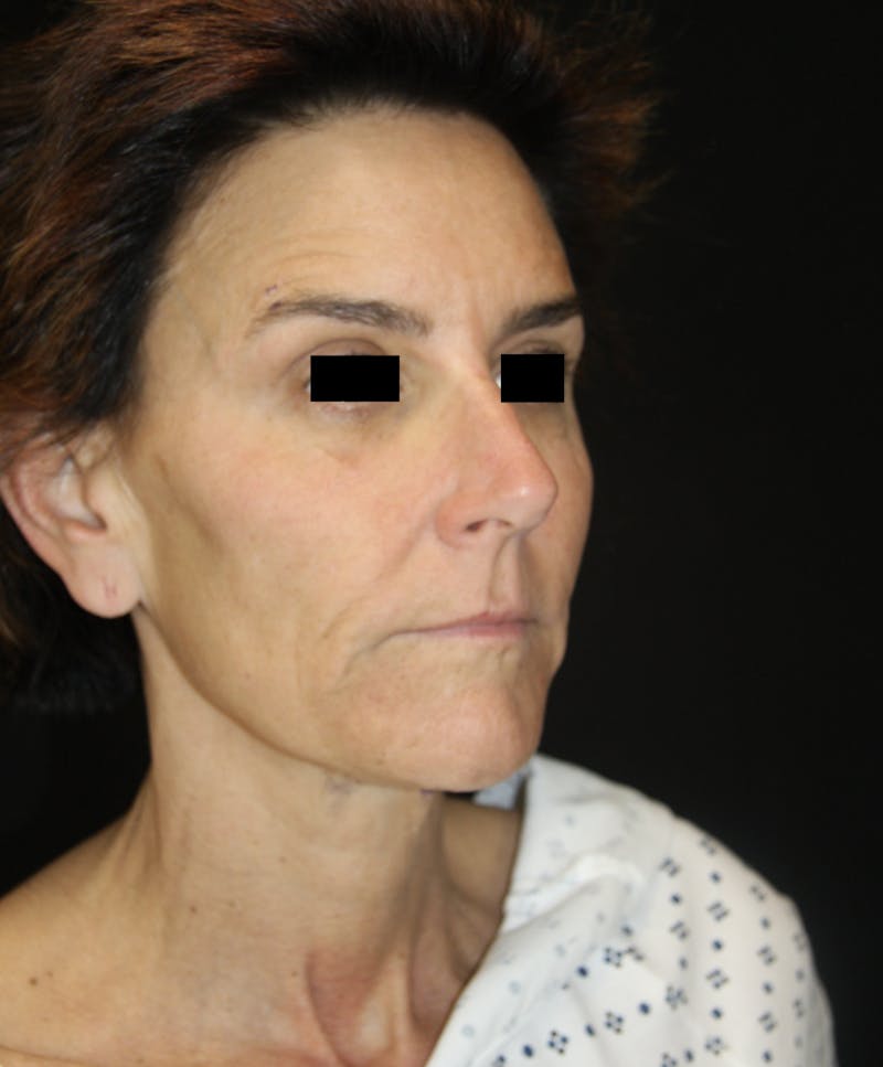 Facelift & Neck Lift Before & After Gallery - Patient 173336136 - Image 5