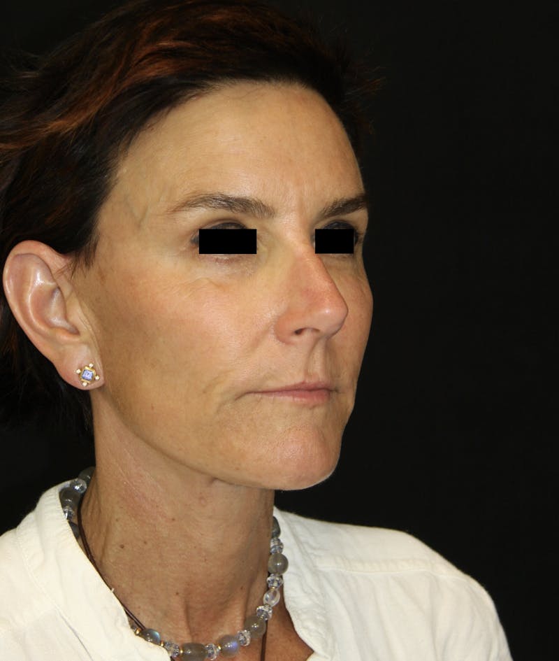 Facelift & Neck Lift Before & After Gallery - Patient 173336136 - Image 6