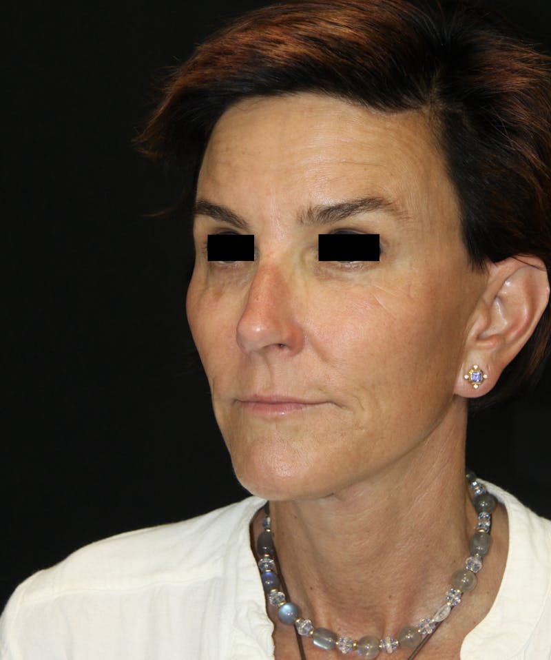 Facelift & Neck Lift Before & After Gallery - Patient 173336136 - Image 2
