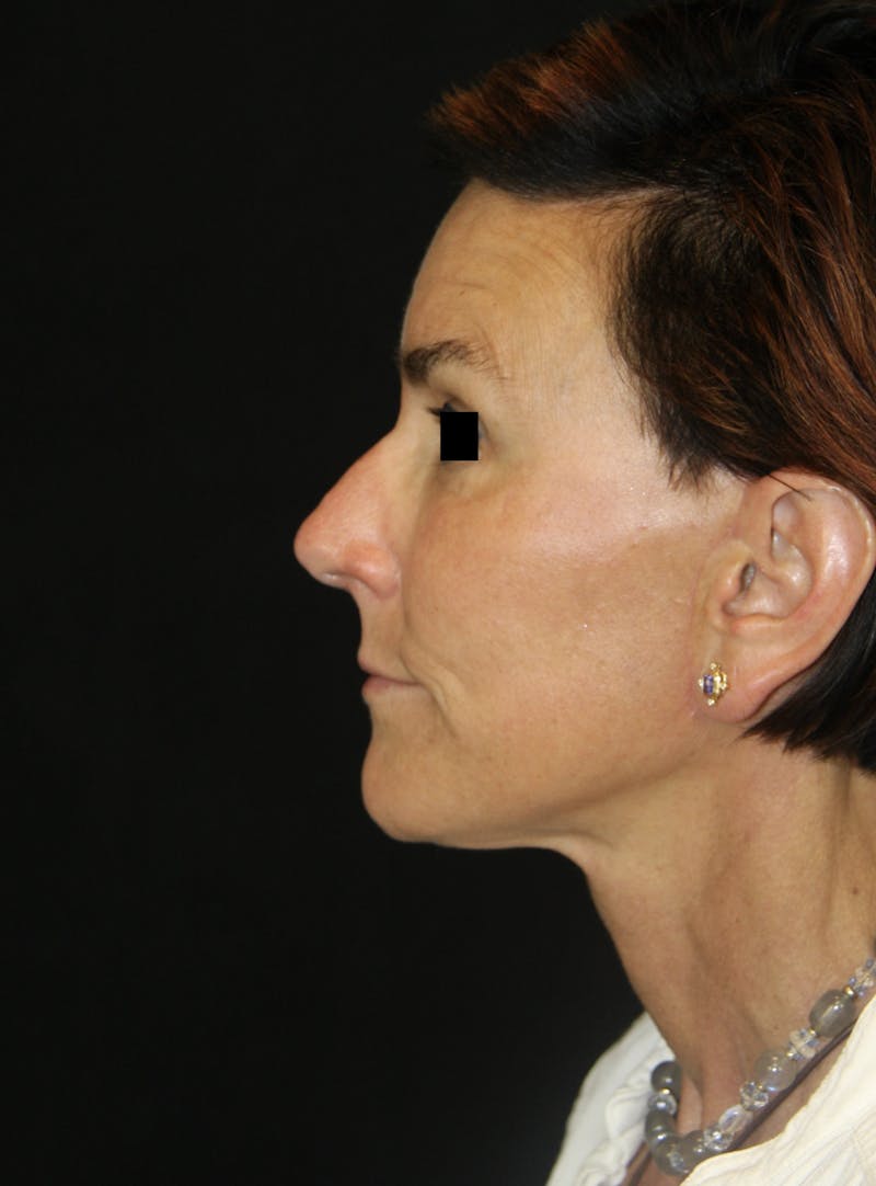 Facelift & Neck Lift Before & After Gallery - Patient 173336136 - Image 4