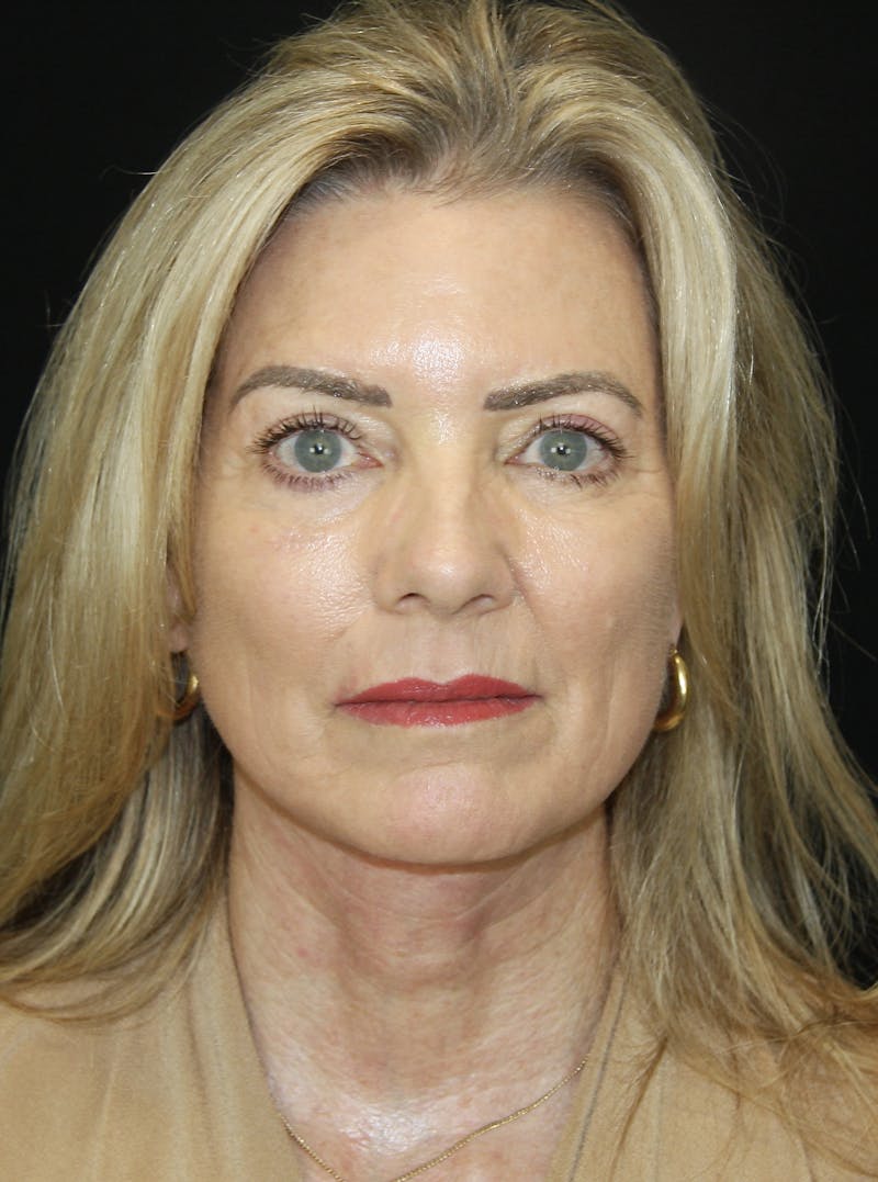 Facelift & Neck Lift Before & After Gallery - Patient 173336194 - Image 2