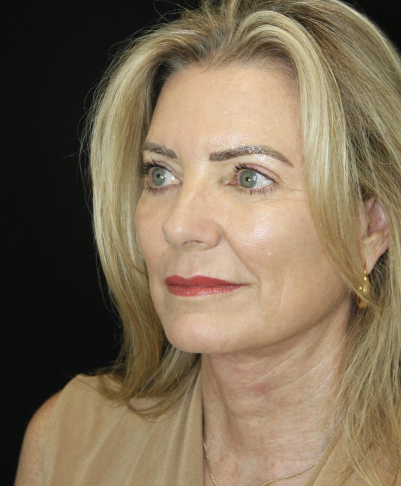 Facelift & Neck Lift Before & After Gallery - Patient 173336194 - Image 4