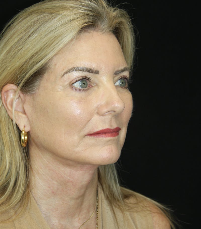 Facelift & Neck Lift Before & After Gallery - Patient 173336194 - Image 8