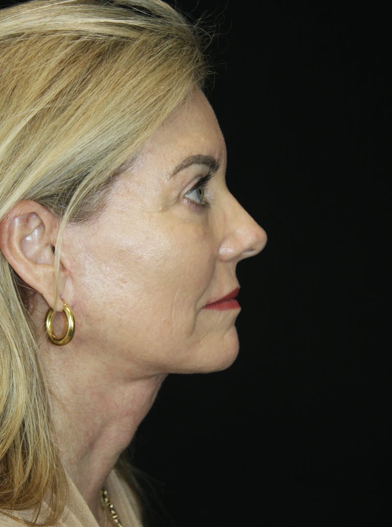 Facelift & Neck Lift Before & After Gallery - Patient 173336194 - Image 6