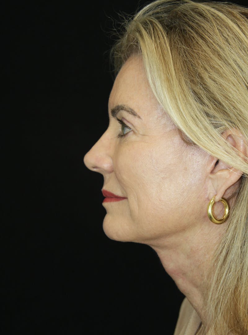 Facelift & Neck Lift Before & After Gallery - Patient 173336194 - Image 10