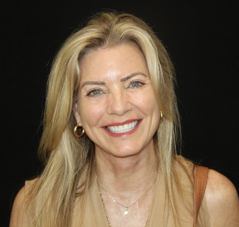 Facelift & Neck Lift Before & After Gallery - Patient 173336194 - Image 11