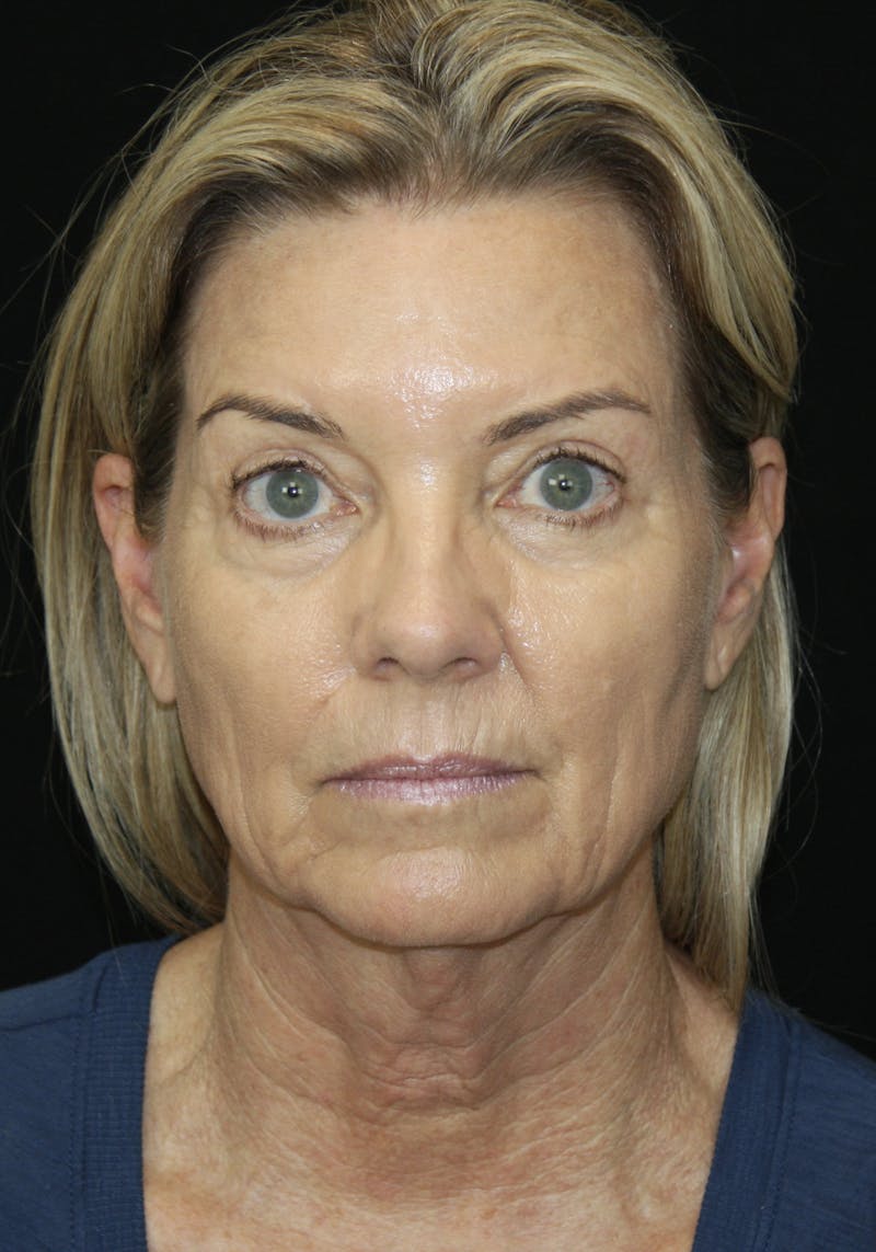 Facelift & Neck Lift Before & After Gallery - Patient 173336194 - Image 1