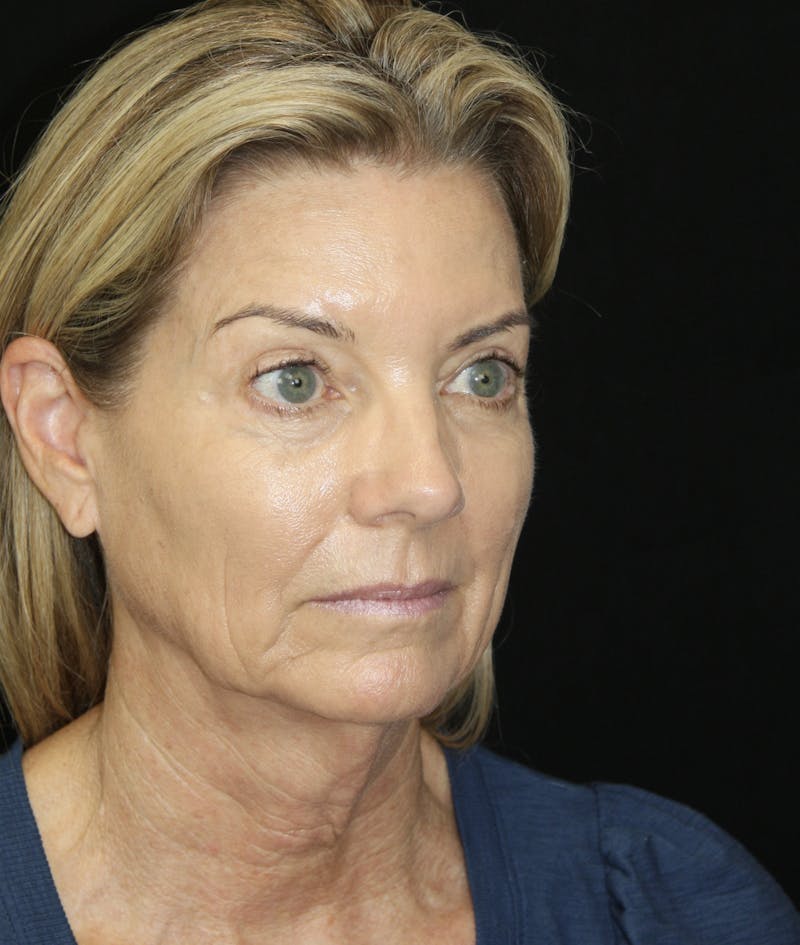 Facelift & Neck Lift Before & After Gallery - Patient 173336194 - Image 7