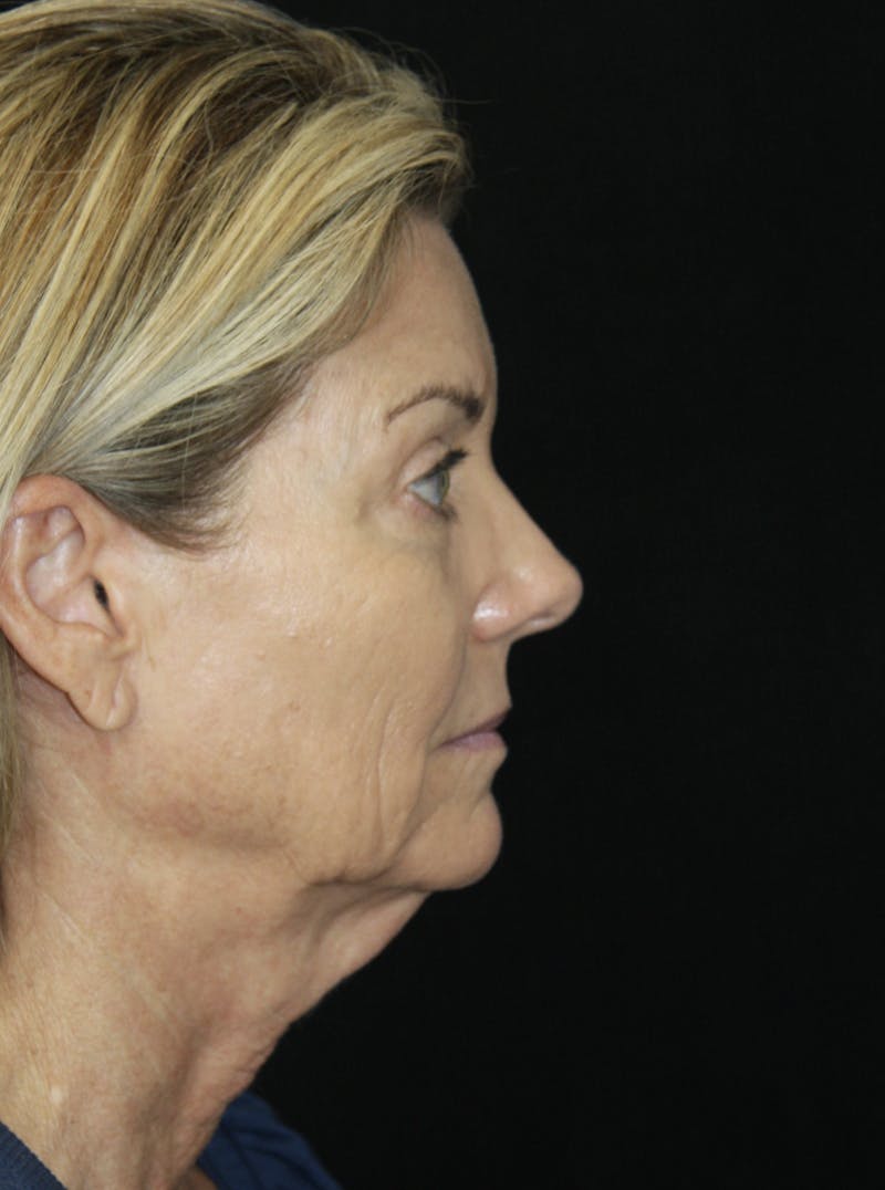 Facelift & Neck Lift Before & After Gallery - Patient 173336194 - Image 5