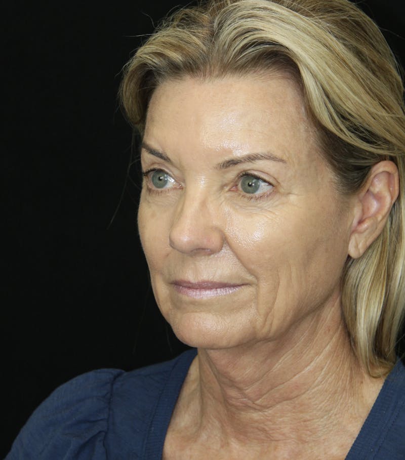Facelift & Neck Lift Before & After Gallery - Patient 173336194 - Image 3