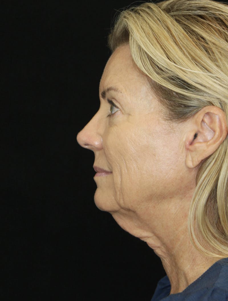Facelift & Neck Lift Before & After Gallery - Patient 173336194 - Image 9