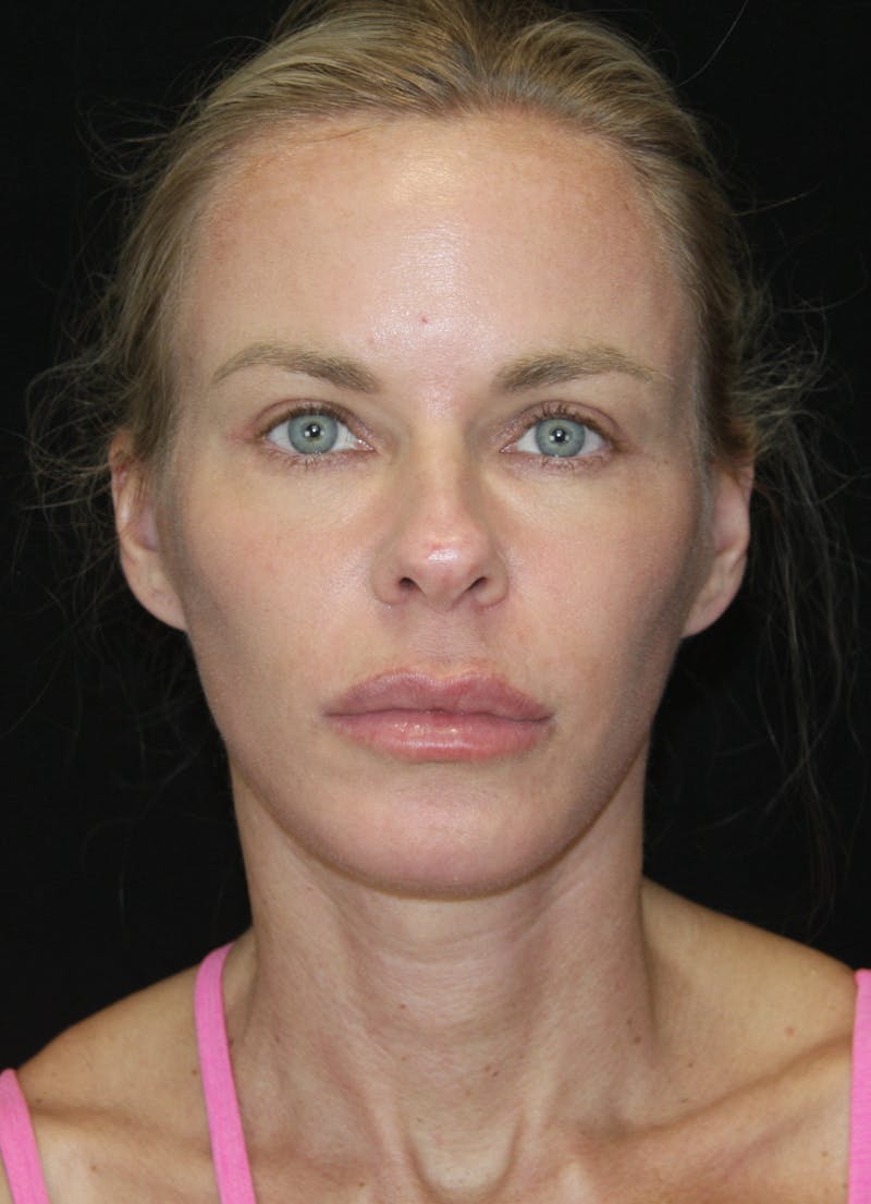 Facelift & Neck Lift Before & After Gallery - Patient 173336307 - Image 2