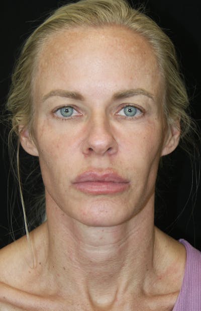 Facelift & Neck Lift Before & After Gallery - Patient 173336307 - Image 1
