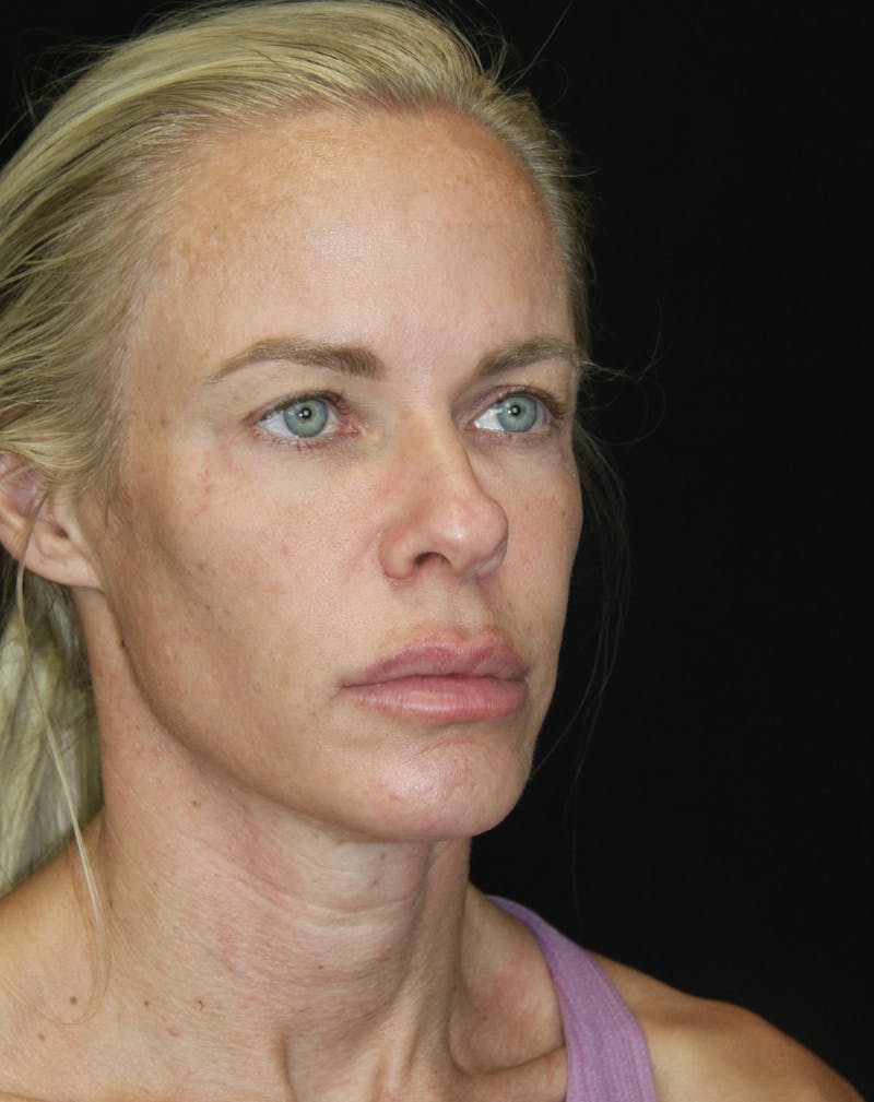 Facelift & Neck Lift Before & After Gallery - Patient 173336307 - Image 3
