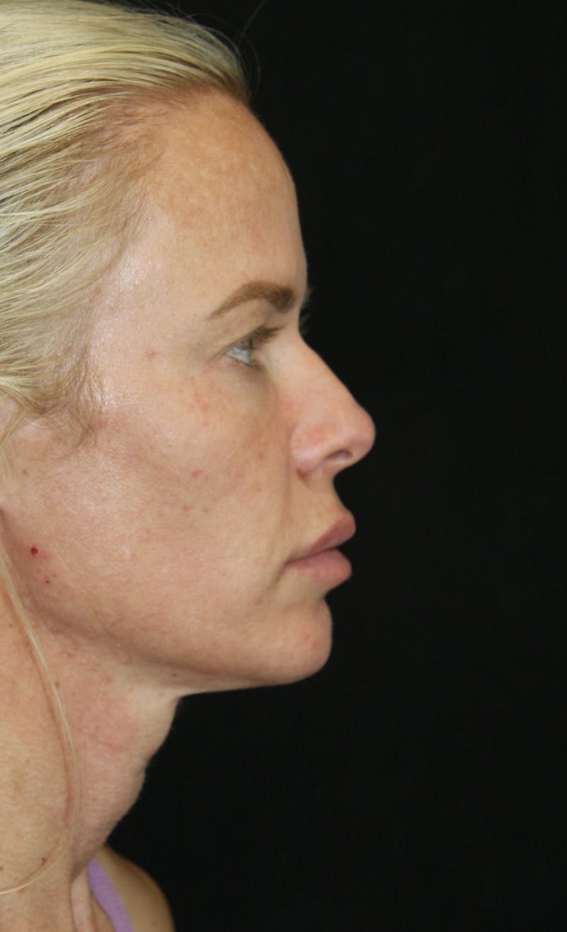 Facelift & Neck Lift Before & After Gallery - Patient 173336307 - Image 5