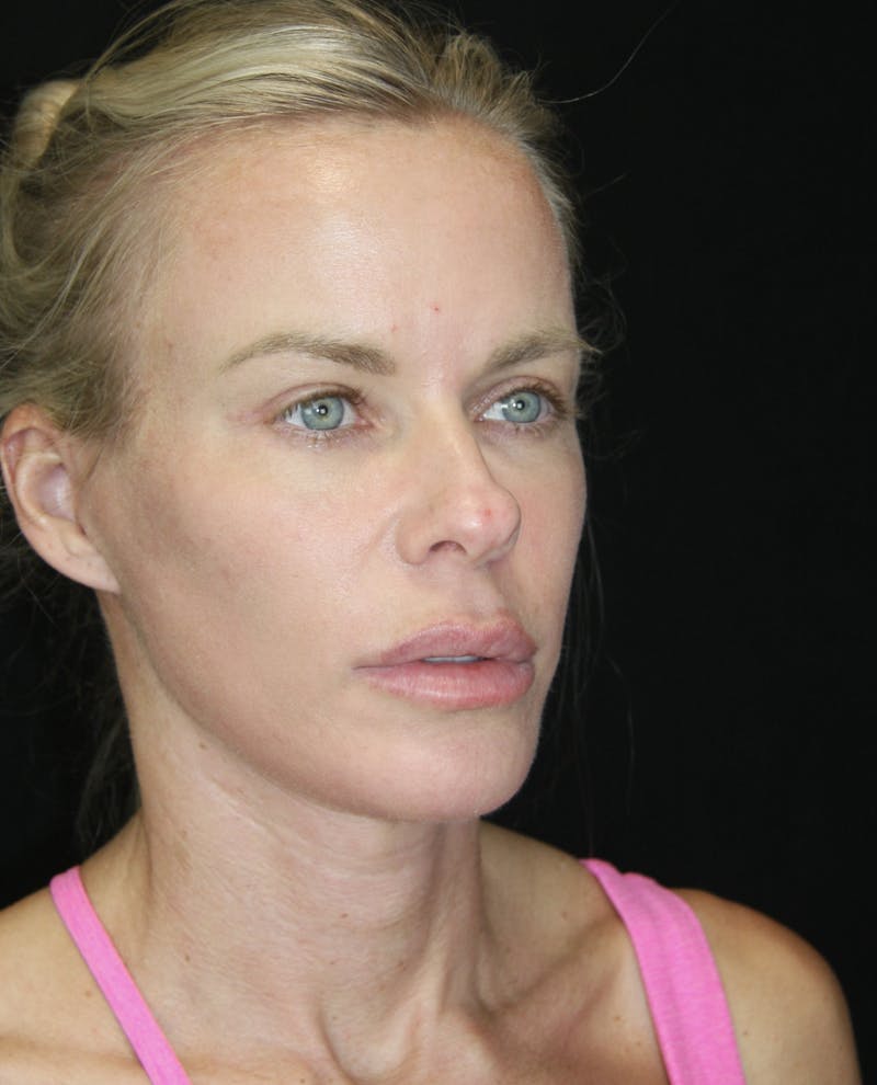 Facelift & Neck Lift Before & After Gallery - Patient 173336307 - Image 4