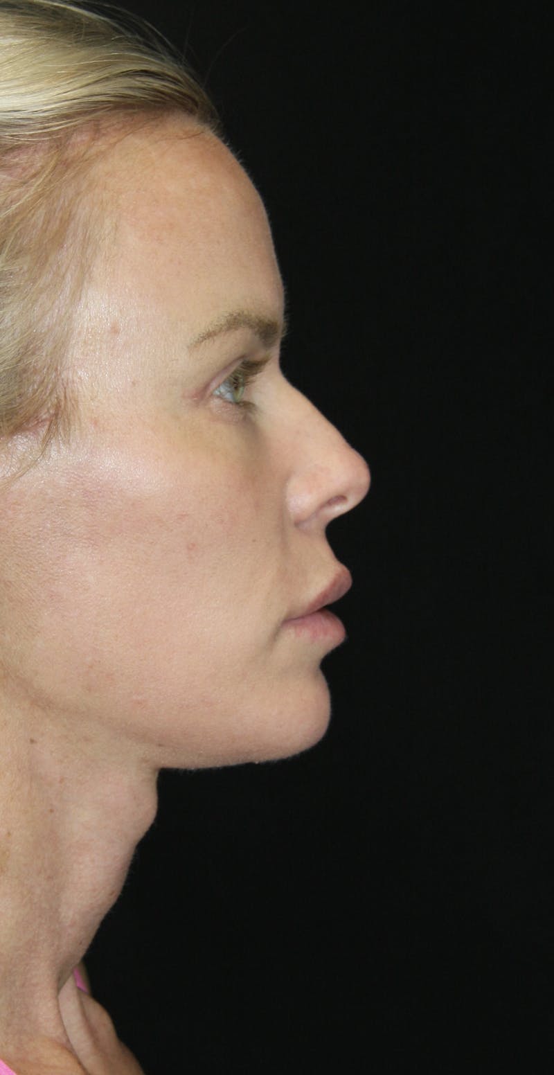 Facelift & Neck Lift Before & After Gallery - Patient 173336307 - Image 6