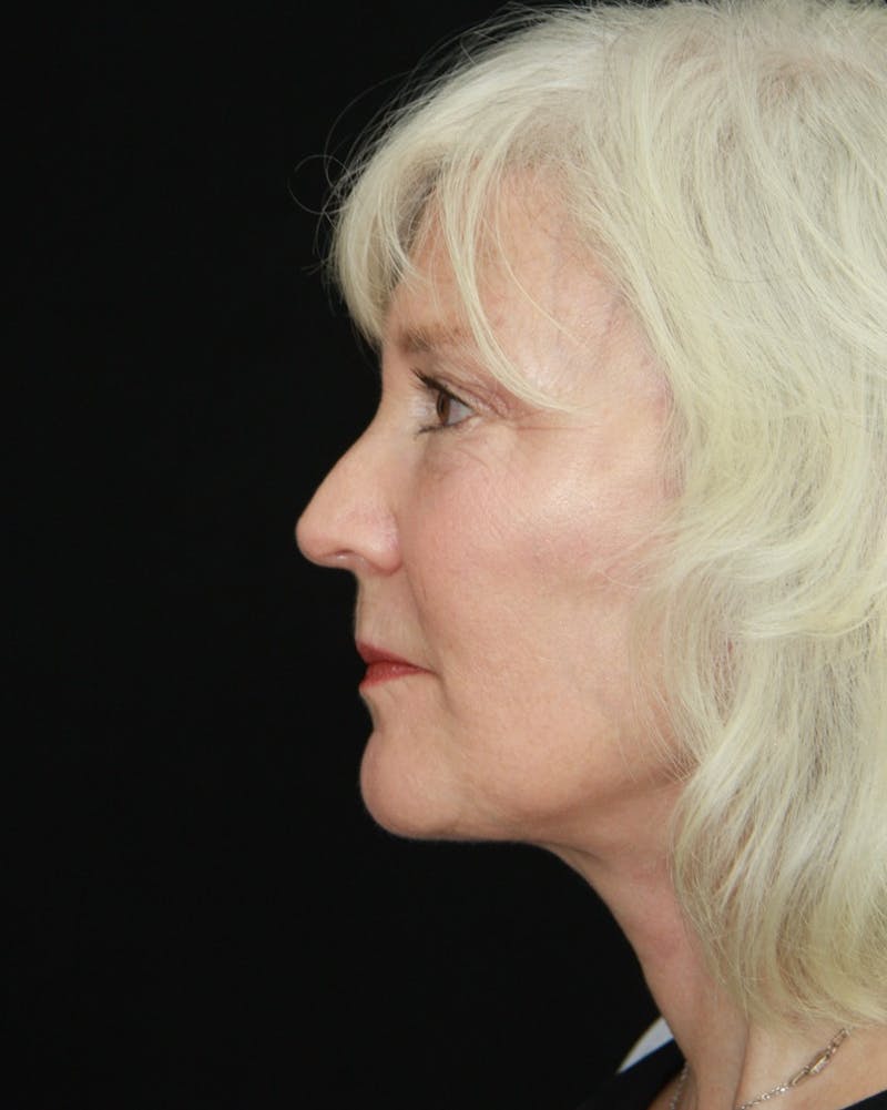 Facelift & Neck Lift Before & After Gallery - Patient 173338099 - Image 6