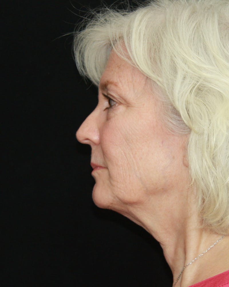 Facelift & Neck Lift Before & After Gallery - Patient 173338099 - Image 5