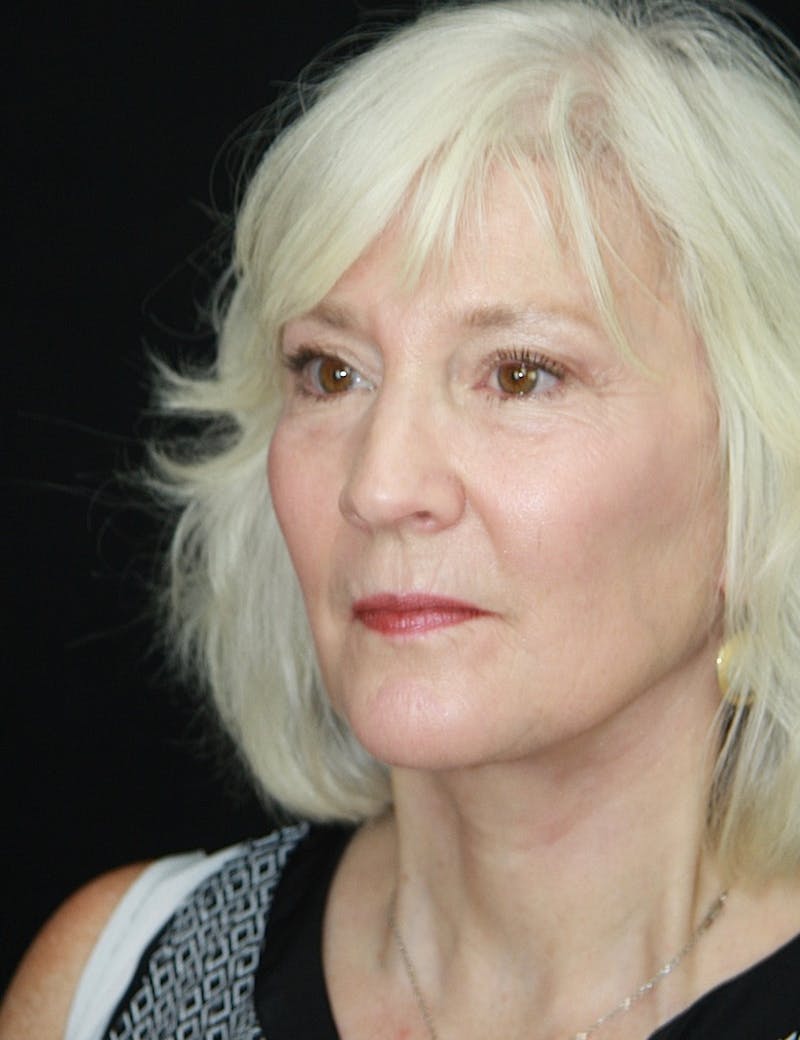 Facelift & Neck Lift Before & After Gallery - Patient 173338099 - Image 4