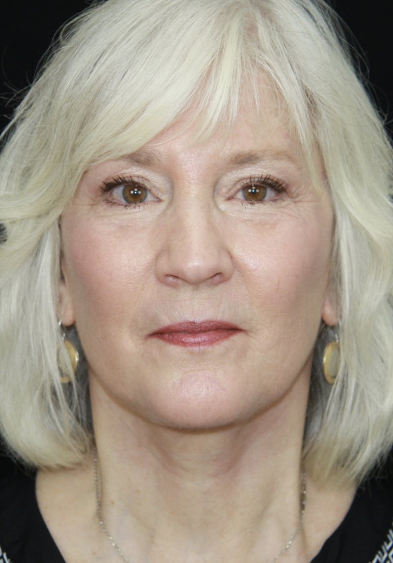 Facelift & Neck Lift Before & After Gallery - Patient 173338099 - Image 2