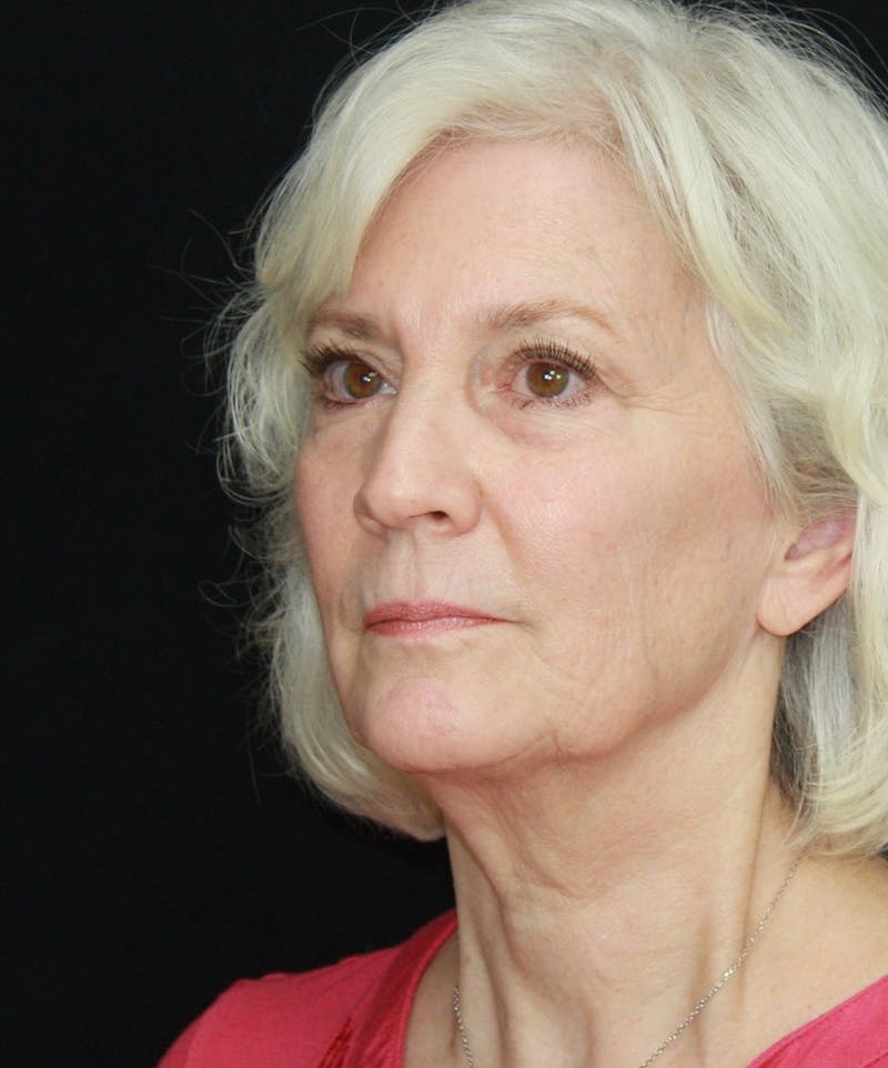 Facelift & Neck Lift Before & After Gallery - Patient 173338099 - Image 3