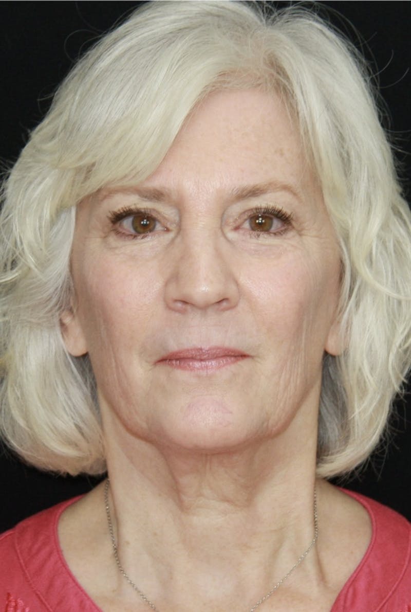 Facelift & Neck Lift Before & After Gallery - Patient 173338099 - Image 1