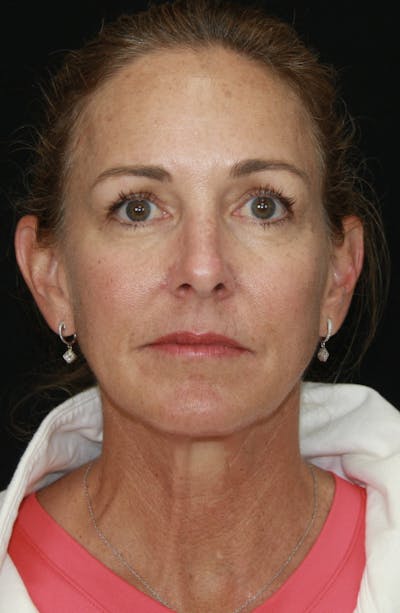 Facelift & Neck Lift Before & After Gallery - Patient 173338379 - Image 1