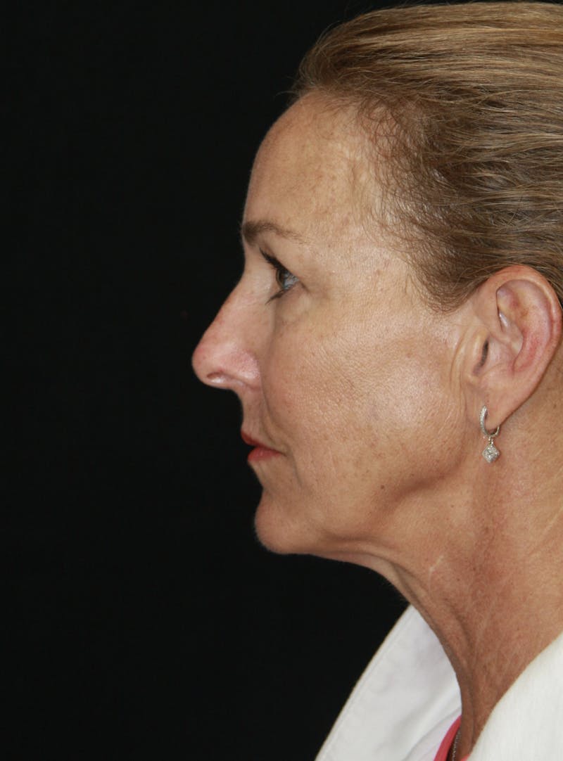 Facelift & Neck Lift Before & After Gallery - Patient 173338379 - Image 5