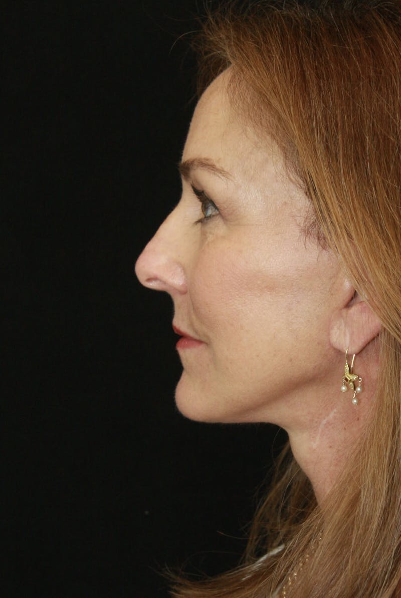 Facelift & Neck Lift Before & After Gallery - Patient 173338379 - Image 6