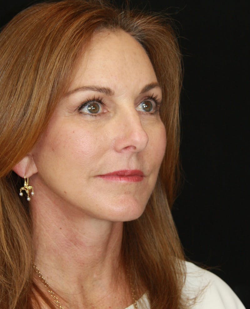Facelift & Neck Lift Before & After Gallery - Patient 173338379 - Image 8