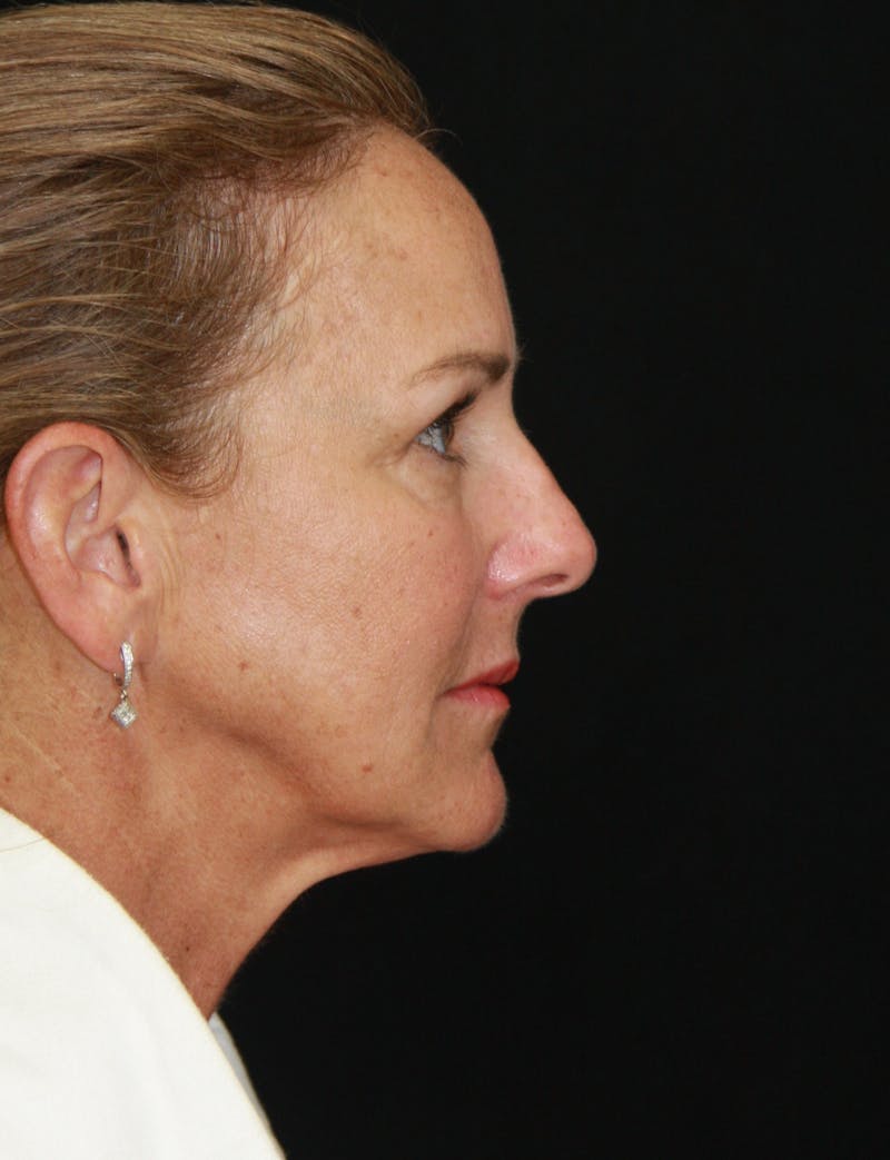 Facelift & Neck Lift Before & After Gallery - Patient 173338379 - Image 9