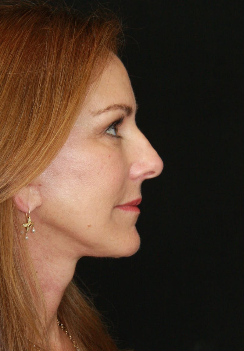 Facelift & Neck Lift Before & After Gallery - Patient 173338379 - Image 10
