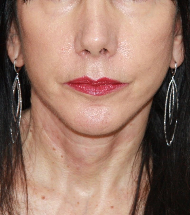 Facelift & Neck Lift Before & After Gallery - Patient 173338554 - Image 2