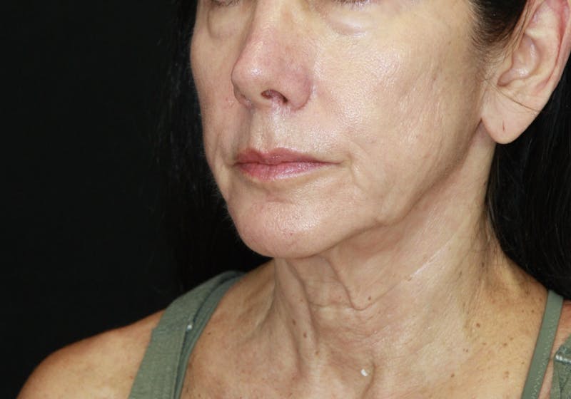 Facelift & Neck Lift Before & After Gallery - Patient 173338554 - Image 3