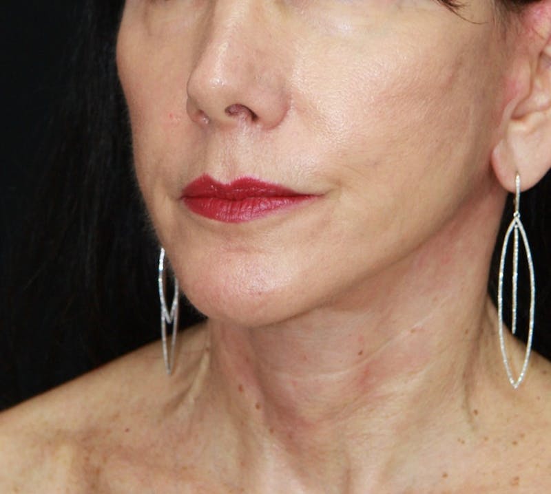 Facelift & Neck Lift Before & After Gallery - Patient 173338554 - Image 4