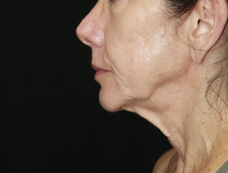 Facelift & Neck Lift Before & After Gallery - Patient 173338554 - Image 5
