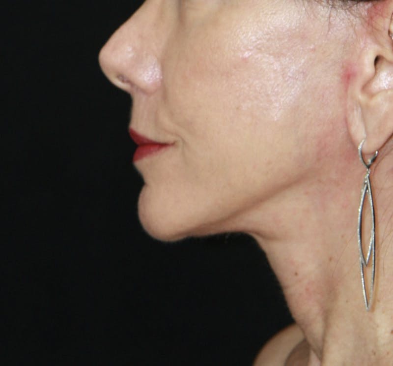 Facelift & Neck Lift Before & After Gallery - Patient 173338554 - Image 6
