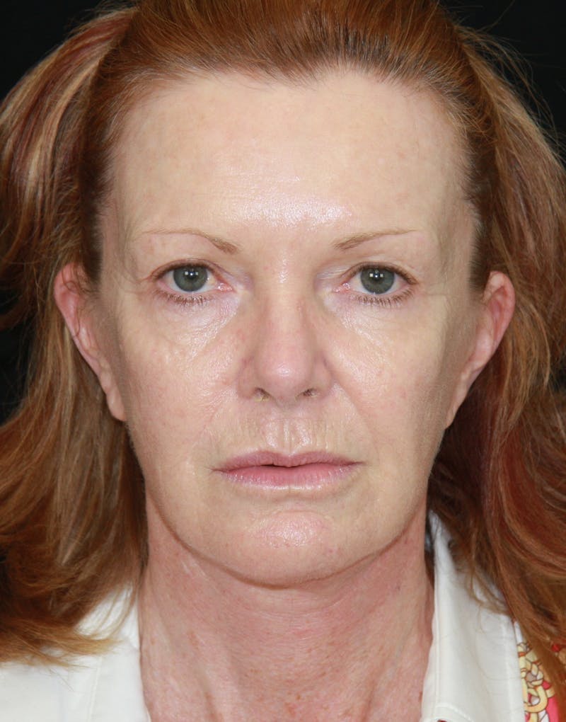 Facelift & Neck Lift Before & After Gallery - Patient 173364514 - Image 1